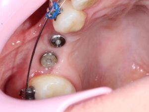 implantes